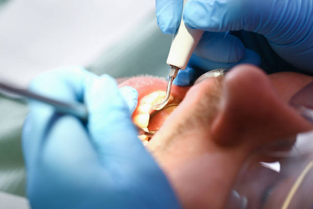 Best Emergency Wisdom Tooth Extraction in Weatherford, TX