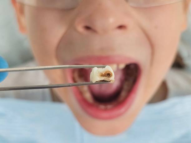 Best Broken or Chipped Tooth Repair in Weatherford, TX